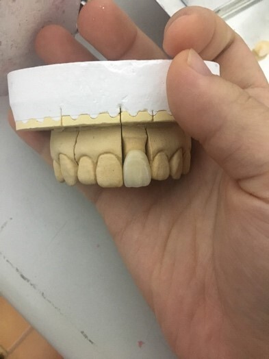 陶瓷燒附金屬冠最後成品